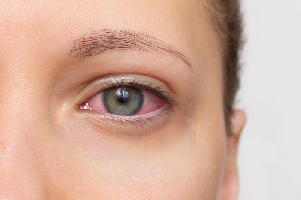 Allergie oculari in primavera con occhi arrossati e lacrimazione