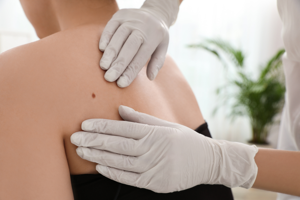 Mappatura dei nei e prevenzione melanoma con protezione solare